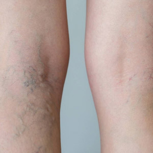 Spider Veins Removal Treatment Near Me in Dearborn, MI