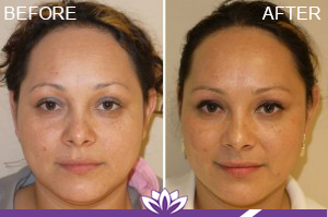 Chemical Peel in Dearborn, MI