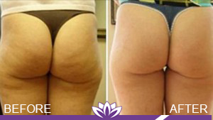 Cellulite Reduction in Dearborn, MI