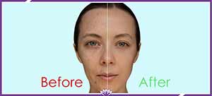 Chemical Peel Treatment Near Me in Dearborn, MI Chemical Peel Treatment Near Me in Dearborn, MI