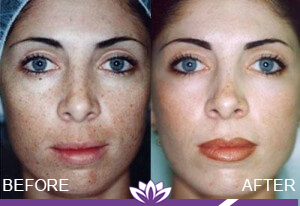 Microdermabrasion in Dearborn, MI