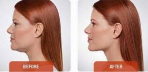 Before and After kybella in Michigan