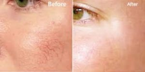 Spider Veins Removal Treatment Near Me in Dearborn, MI