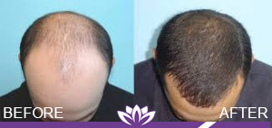 Hair Restoration in Dearborn, MI