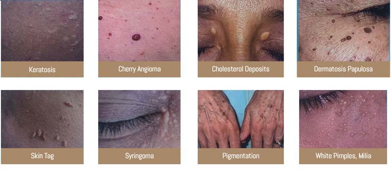 Skin Tags Removal Clinic Near Me in Dearborn, MI Skin Tags Removal Clinic Near Me in Dearborn, MI