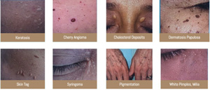 Skin Tags Removal Clinic Near Me in Dearborn, MI