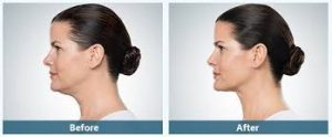 Before and After kybella in Michigan