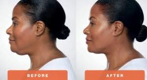 Before and After kybella in Michigan