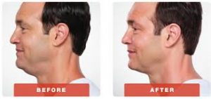 Before and After kybella in Michigan