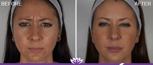 Before and After Juvederm