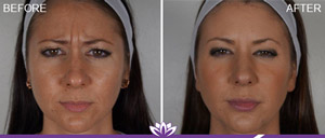 Before and After Juvederm