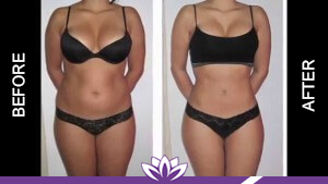 Body Contouring in Dearborn, MI