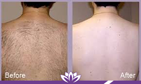 Laser Hair Removal in Dearborn, MI