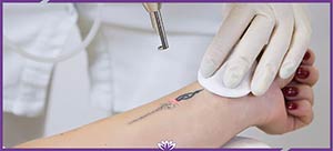 Picoway Laser Tattoo Removal Near Me in Dearborn, MI Picoway Laser Tattoo Removal Near Me in Dearborn, MI