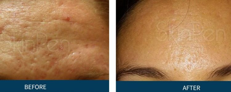 Microneedling Services Near Me in Dearborn, MI