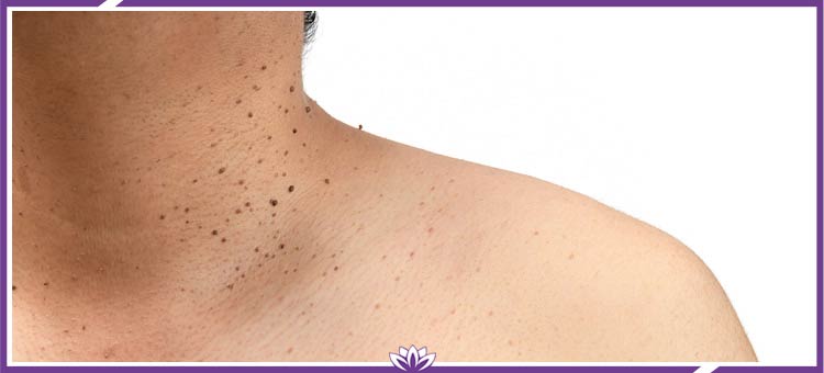 Skin Tags Removal Clinic Near Me in Dearborn, MI Skin Tags Removal Clinic Near Me in Dearborn, MI