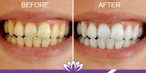 Teeth Whitening in Dearborn, MI