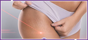 Stretch Marks Removal With Picoway Resolve Laser in Dearborn, MI Stretch Marks Removal With Picoway Resolve Laser in Dearborn, MI