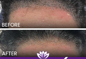 Hairline Laser Tattoo Removal in Dearborn, MI