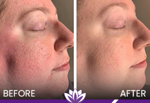 Rosacea Treatment with PicoWay Laser and IPL in Dearborn, MI