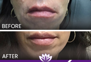 Lip Filler in Dearborn, MI