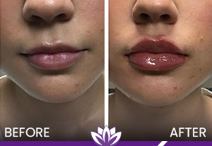 Lip Filler in Dearborn, MI