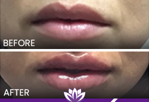 Lip Filler in Dearborn, MI