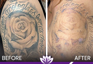 PicoWay Laser Tattoo Removal in Dearborn, MI