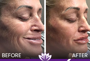 Thread Lift and Dermal Filler in Dearborn, MI