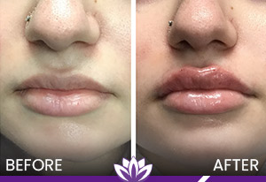 Lip Filler in Dearborn, MI