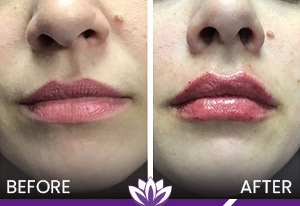 Lip Filler in Dearborn, MI