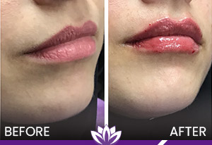 Lip Filler in Dearborn, MI