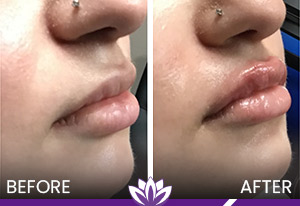 Lip Filler in Dearborn, MI