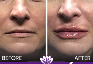 Lip Filler in Dearborn, MI