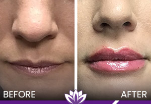 Lip Filler in Dearborn, MI