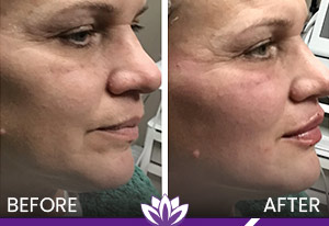 Thread Lift and Dermal Filler in Dearborn, MI