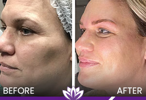 Thread Lift and Dermal Filler in Dearborn, MI