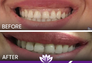 Botox for Gummy Smile in Dearborn, MI