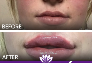 Lip filler with juvederm in Dearborn, MI