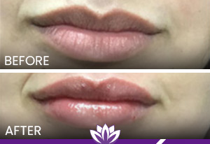 Lip Filler in Dearborn, MI