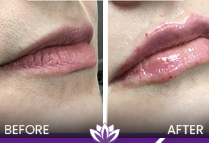 Lip Filler in Dearborn, MI