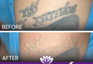 PicoWay Laser Tattoo Removal in Dearborn, MI