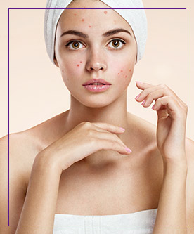 AviClear for Acne Treatment Near Me in Dearborn, Mi