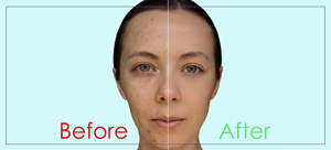 Chemical Peel Treatment Near Me in Dearborn, MI