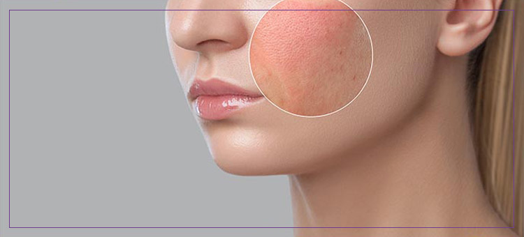 Rosacea Treatment Near Me in Laser Duet MedSpa in Dearborn MI