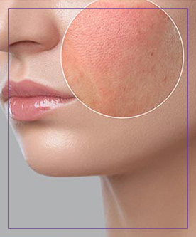 Rosacea Treatment Near Me in Laser Duet MedSpa in Dearborn MI