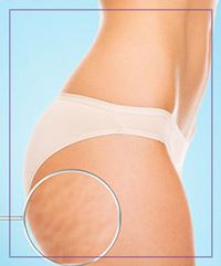 Vaser Shape Cellulite Treatment Near Me in Dearborn, MI