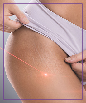 Stretch Marks Removal With Picoway Resolve Laser Near Me in Dearborn, MI