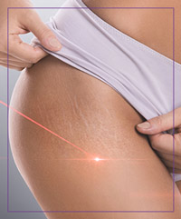 Stretch Marks Removal With Picoway Resolve Laser Near Me in Dearborn, MI