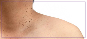 Skin Tags Removal Clinic Near Me in Dearborn, MI